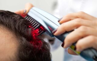 Low-level laser therapy hair loss